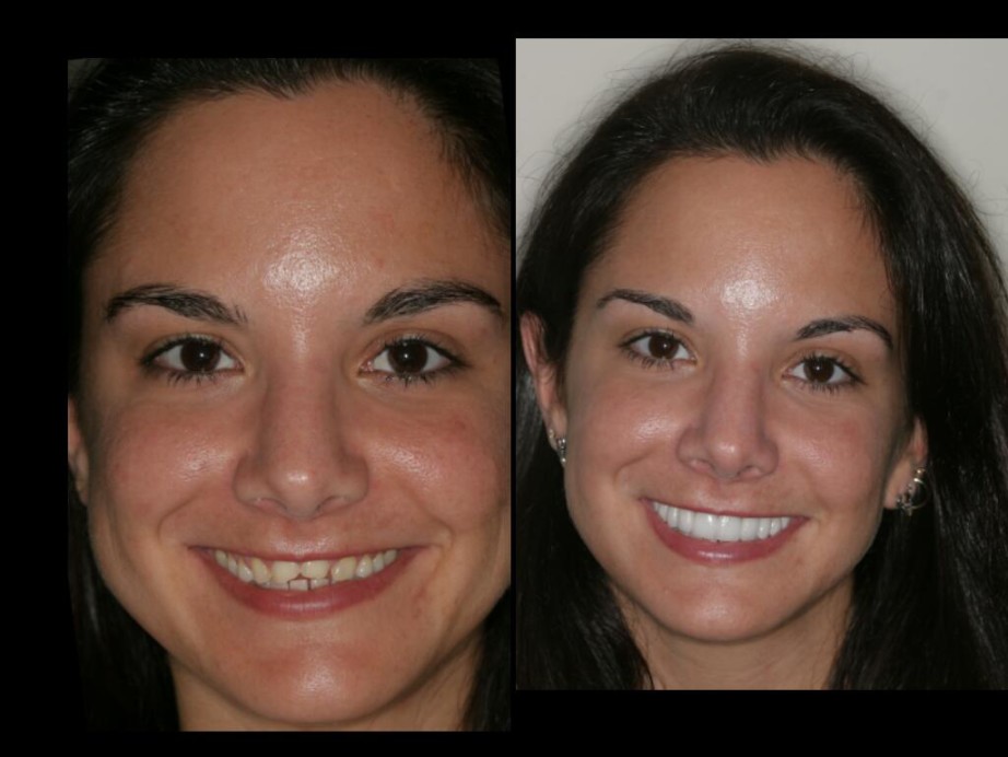 Smile Makeover By Cosmetic Dentistry India