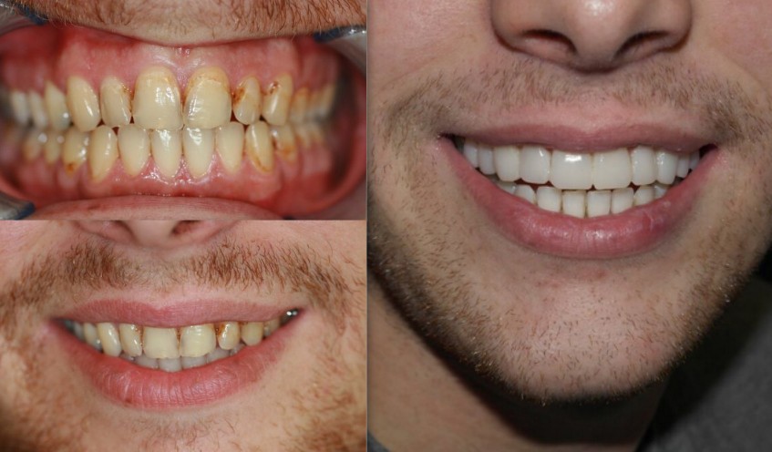 Smile Makeover By Cosmetic Dentistry before after India 2