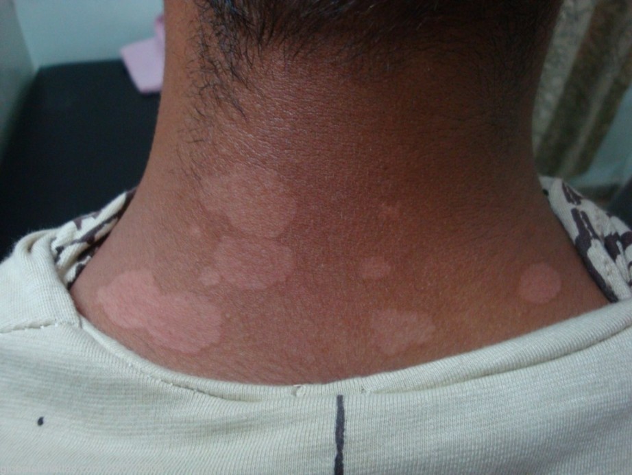 how to use nizoral for tinea versicolor